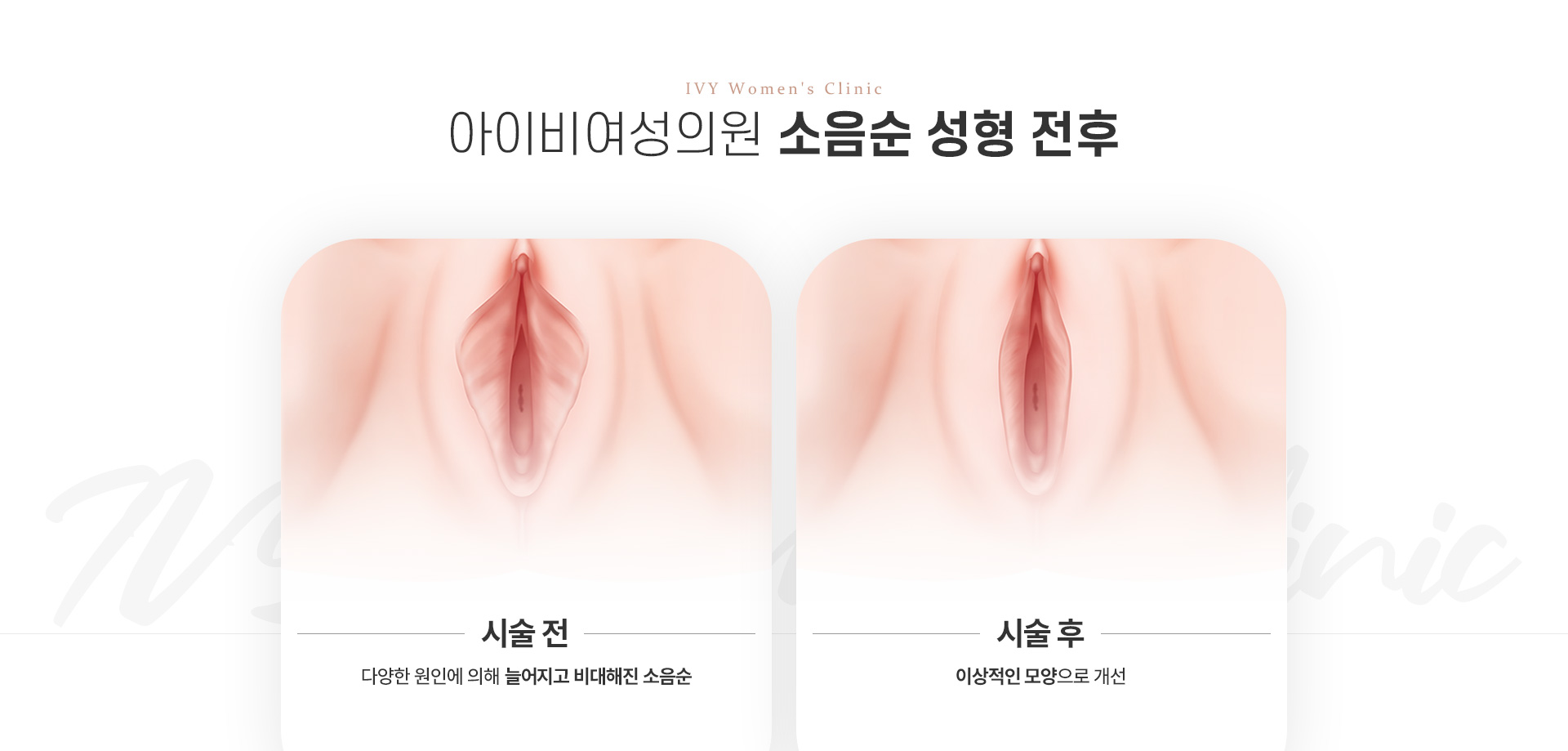 소음순성형 성형전후 